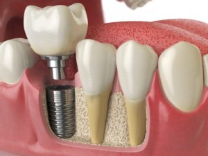 Dental Implants cost in India