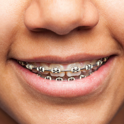 Orthodontic - Get Desire Smile