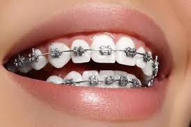 Metal Braces for Orthodontic Treatment