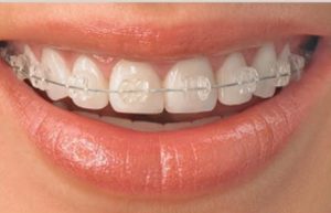 Ceramic braces treatment cost in Chennai and ceramic braces pros and cons 