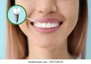 Cost of dental implants in India
