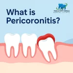 best clinic for Pericoronitis Treatment for Wisdom Tooth result