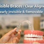 invisible clear aligners